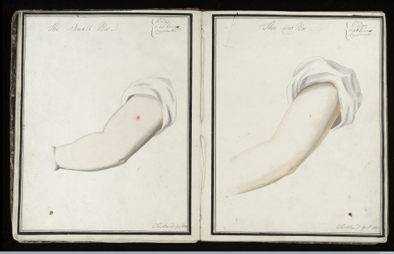 L0039159 Smallpox (left) & cowpox inoculation, day 2