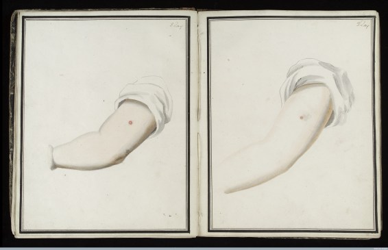 L0039160 Smallpox (left) & cowpox inoculation, day 3