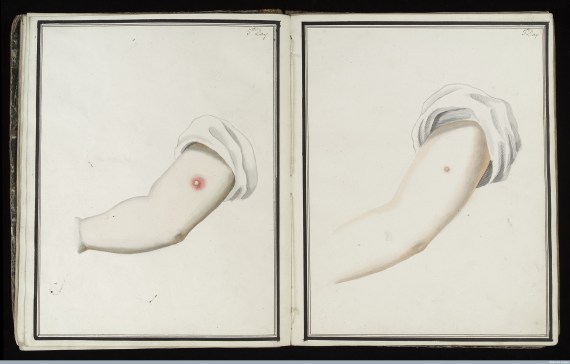 L0039162 Smallpox (left) & cowpox inoculation, day 5