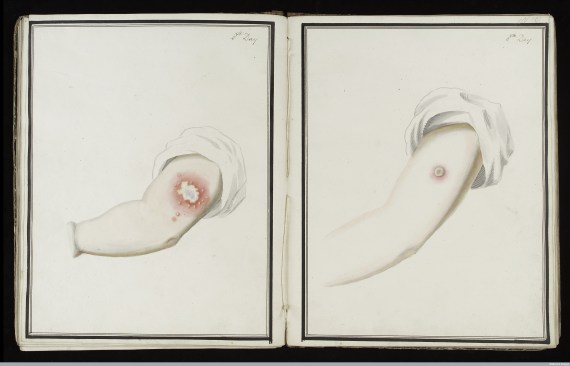 L0039165 Smallpox (left) & cowpox inoculation, day 8