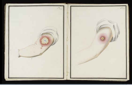 L0039168 Smallpox (left) & cowpox inoculation, day 11