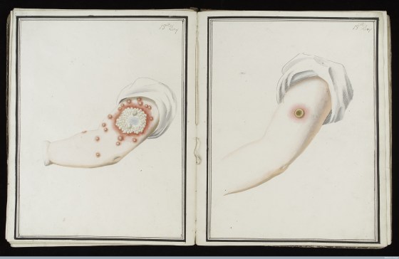 L0039170 Smallpox (left) & cowpox inoculation, day 13